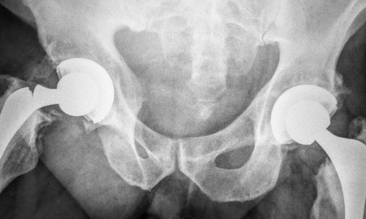 Radiograph showing a fractured Exeter femoral stem in situ