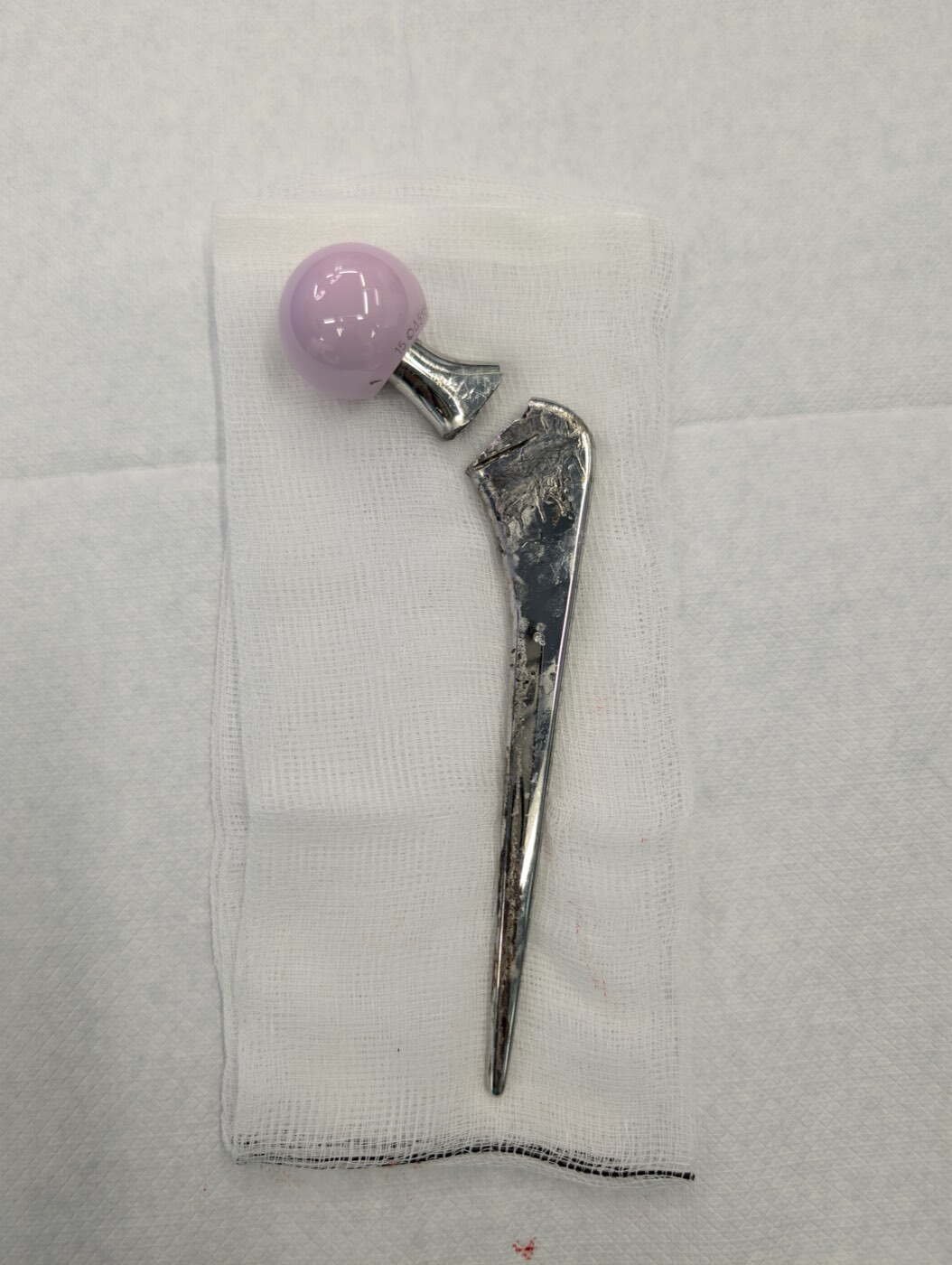 A fractured cemented Exeter femoral stem removed at revision hip surgery