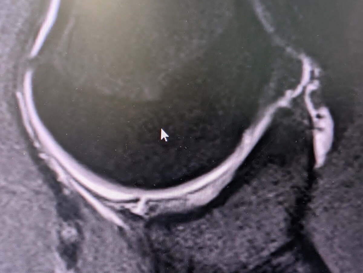 MRI of the shoulder in the ABER sequence showing a Bankart lesion