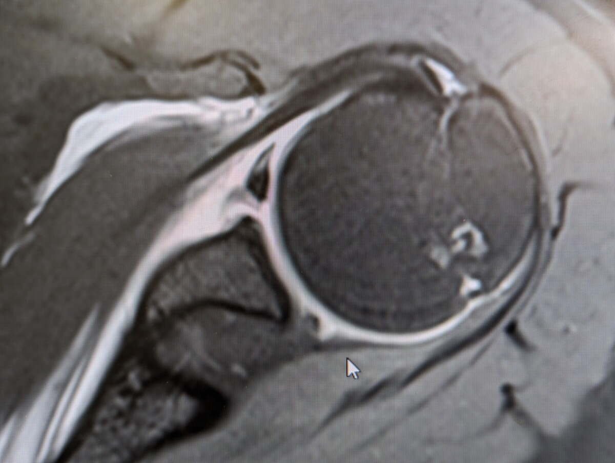 MRI of the shoulder showing a Buford complex, a normal anatomical variant