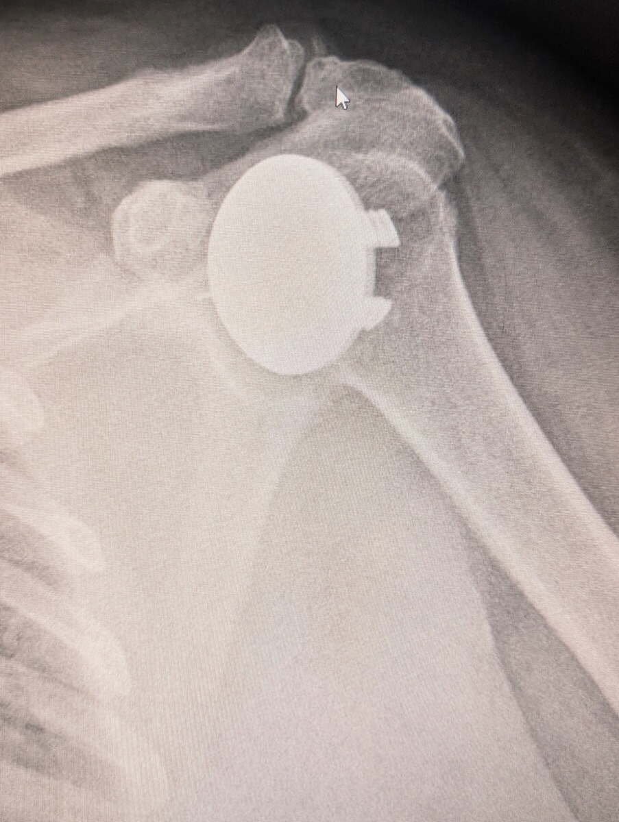 Radiograph showing an anatomic stemless total shoulder replacement