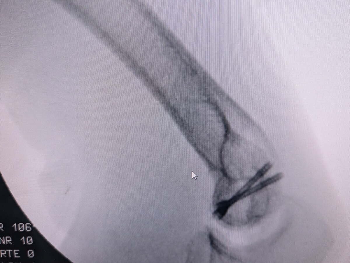 Radiograph of a capitellum fracture fixed with headless compression screws