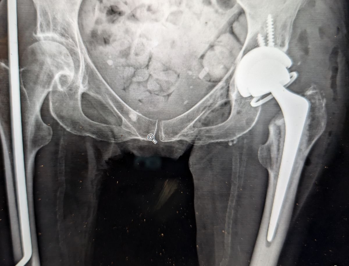 Radiograph of a revision hip replacement using a constrained liner