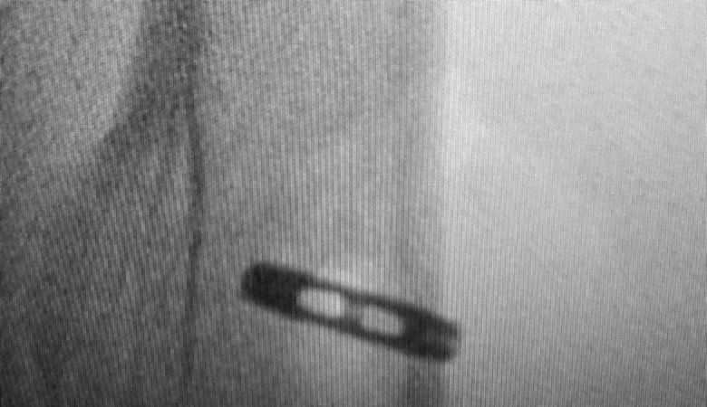 Radiograph of a distal biceps tendon repaired to the radial tuberosity with an endobutton