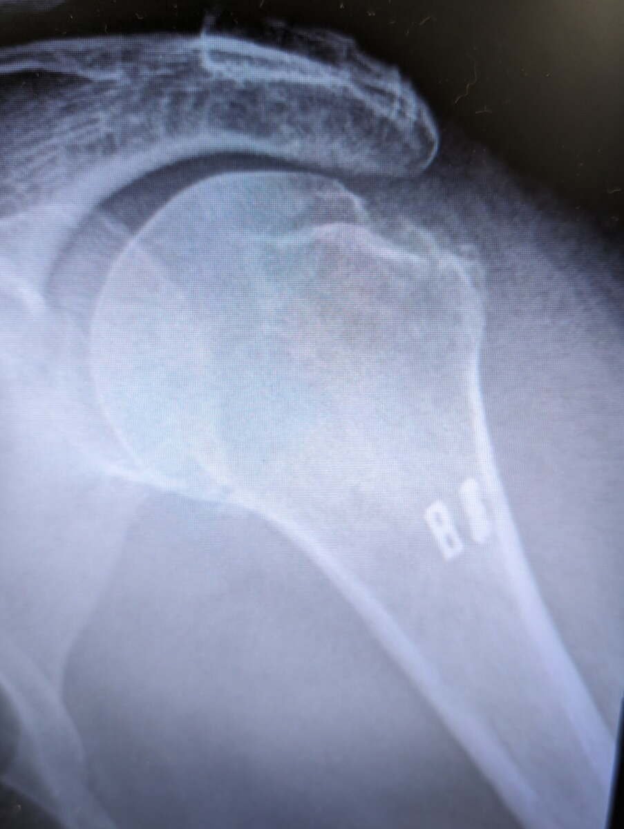 Radiograph of a repaired greater tuberosity fracture using suture anchors and endobuttons