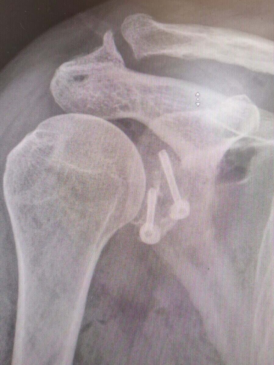 Radiograph of a shoulder after a Latarjet procedure for instability