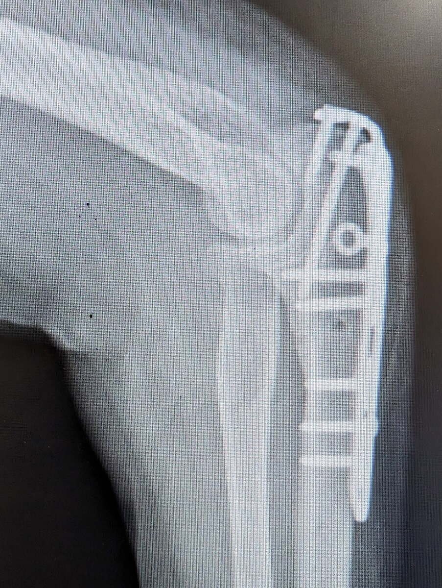 Radiograph of an olecranon fracture fixed with a locking plate