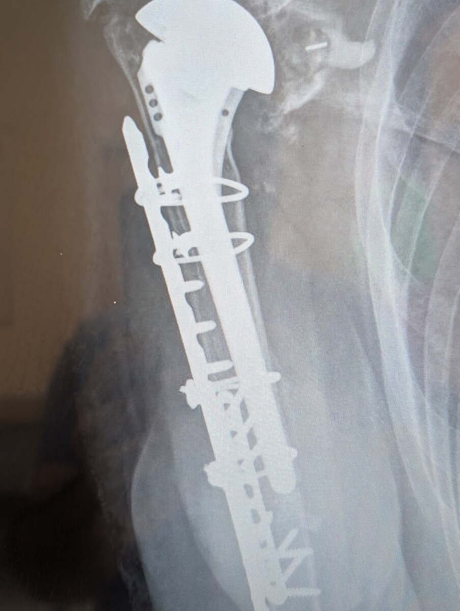 Radiograph showing a periprosthetic humerus fracture fixed with two plates, the original implant preserved