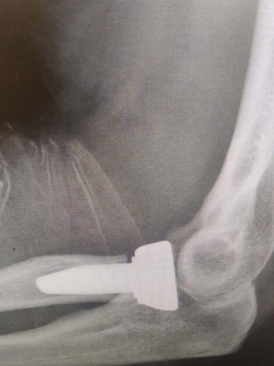 Radiograph of an uncemented radial head replacement