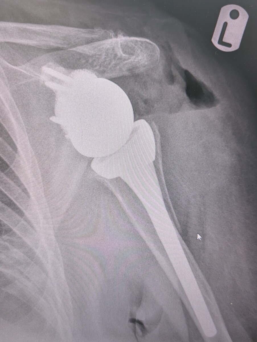 Radiograph of a reverse total shoulder replacement for cuff arthropathy