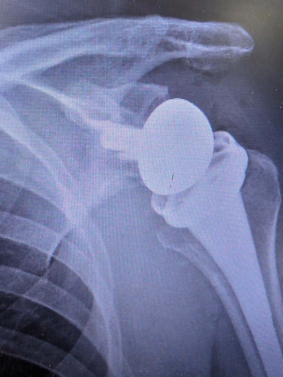 Radiograph of a reverse total shoulder replacement for chronic locked dislocation
