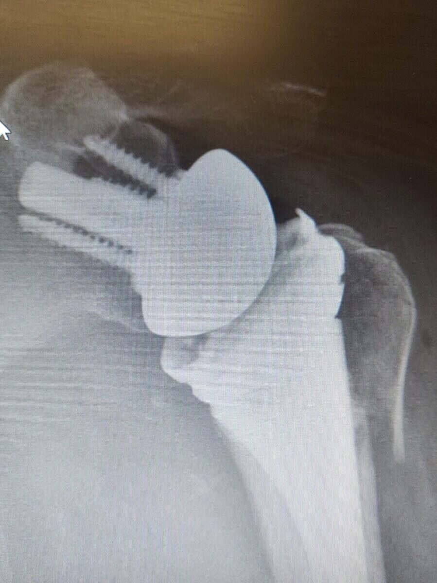 Radiograph of a left reverse total shoulder replacement for an unreconstructible fracture