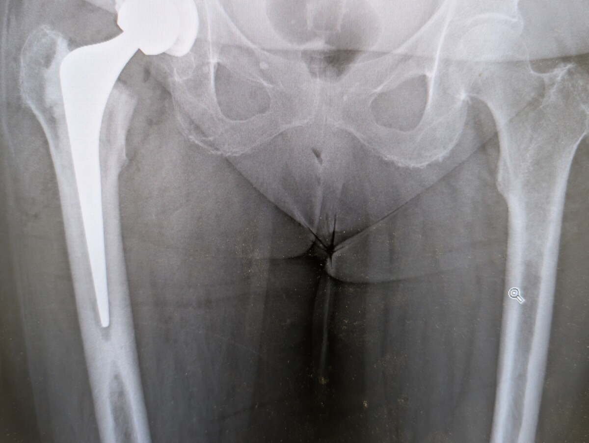 Radiograph of a robotic-assisted total hip replacement