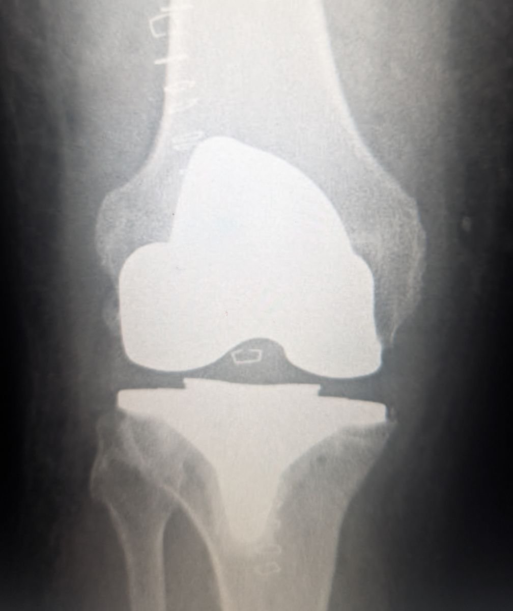 Radiograph of a robotic-assisted total knee replacement showing both femoral and tibial components