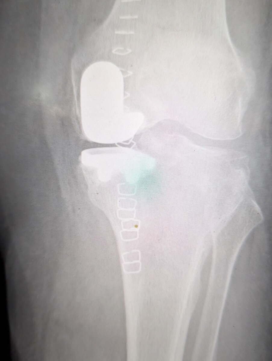 Radiograph of a robotic-assisted medial unicompartmental knee replacement