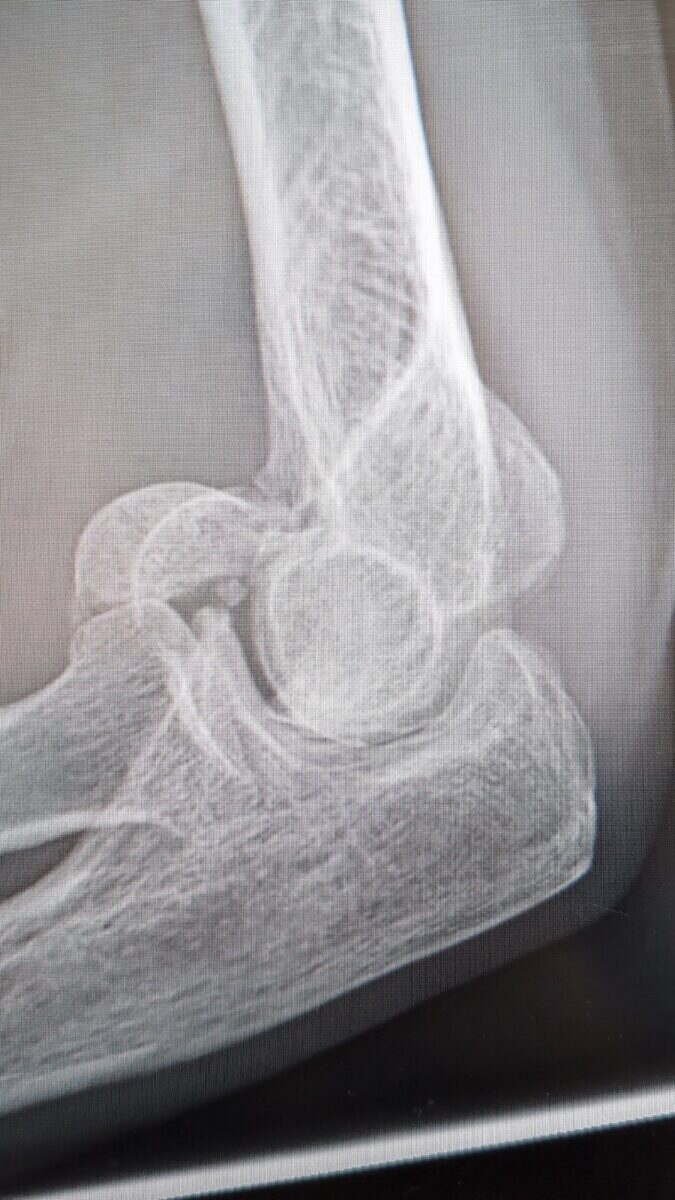 Radiograph of a capitellum shear fracture of the elbow