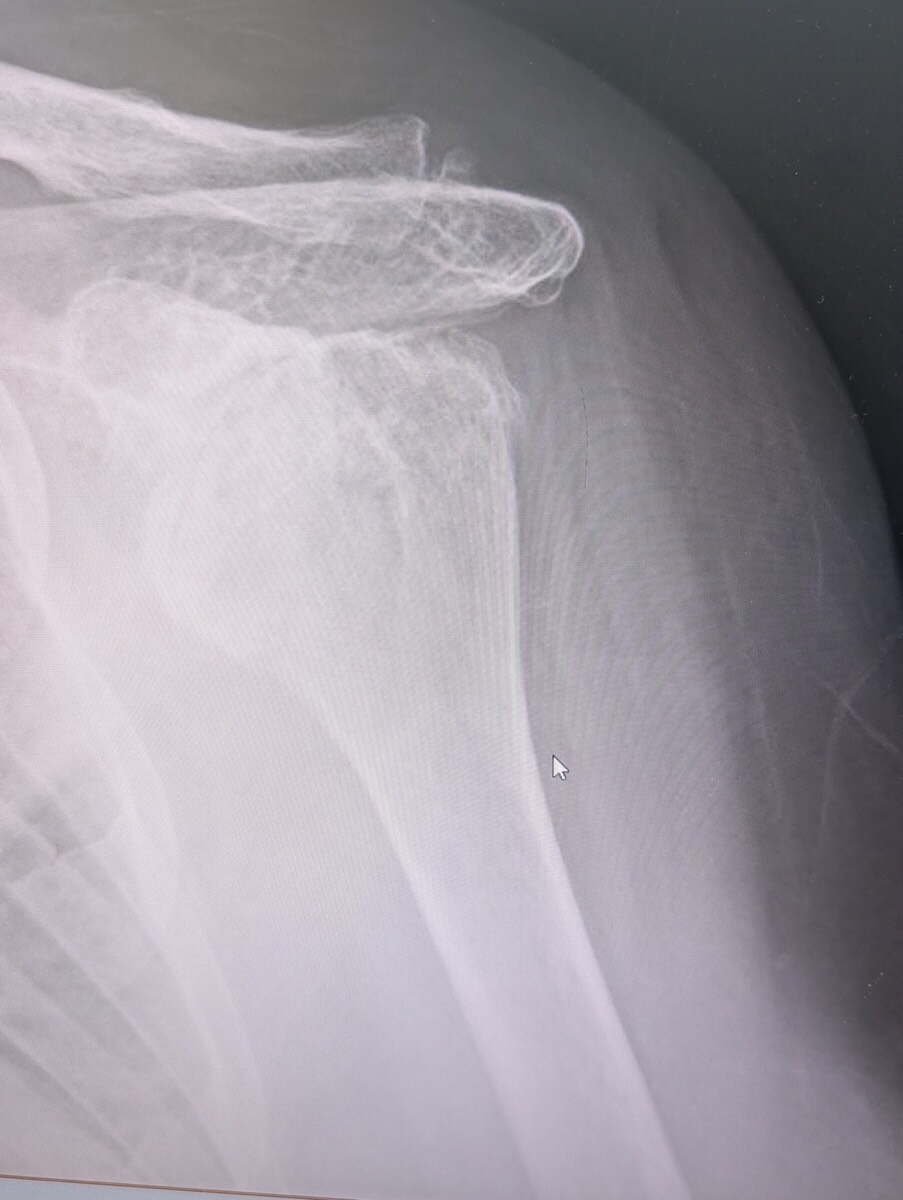 Radiograph of rotator cuff arthropathy, the humeral head risen against the acromion