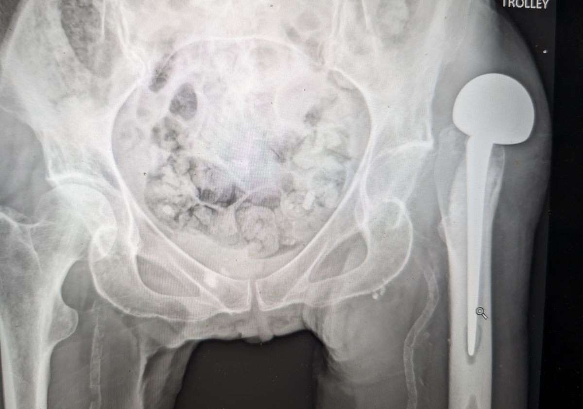 Radiograph of a dislocated hip hemiarthroplasty