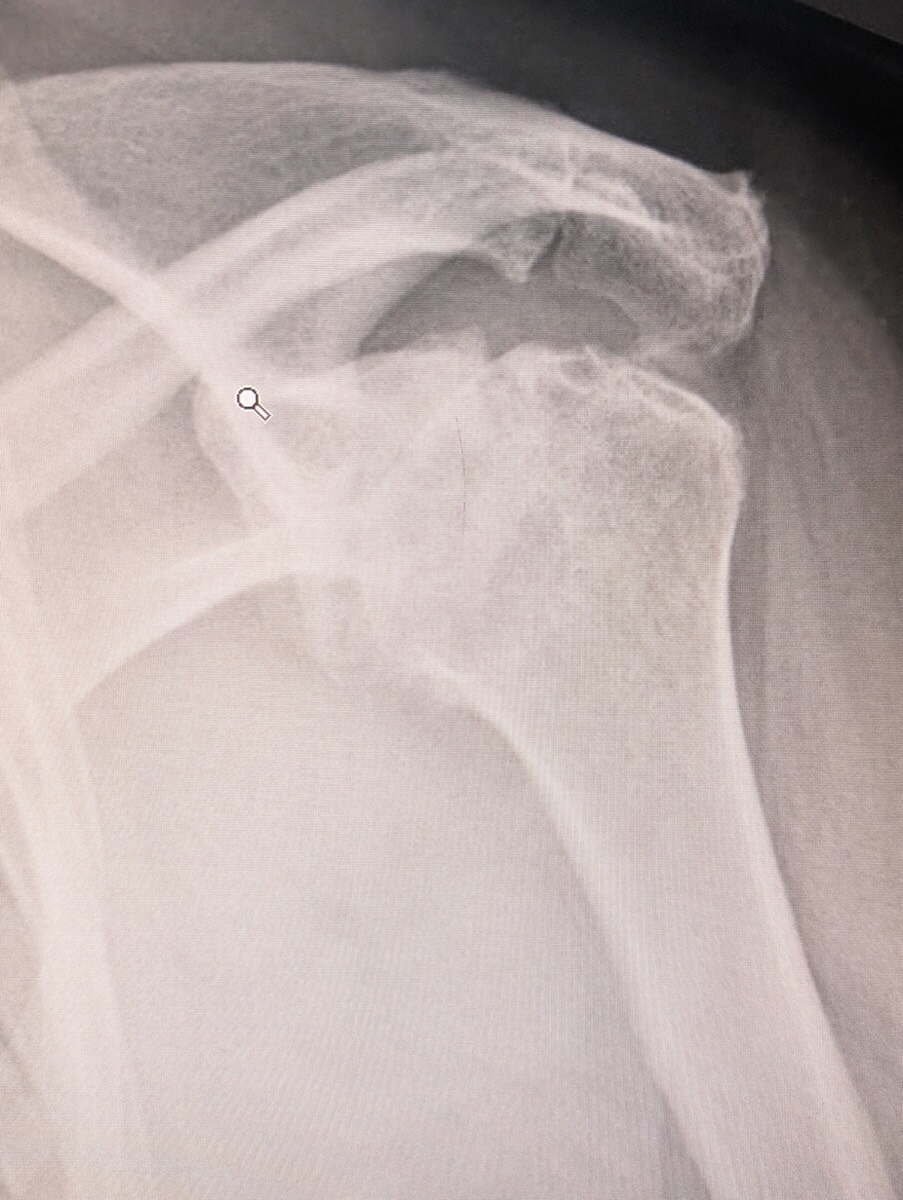 Radiograph of a shoulder with severe glenohumeral osteoarthritis before surgery