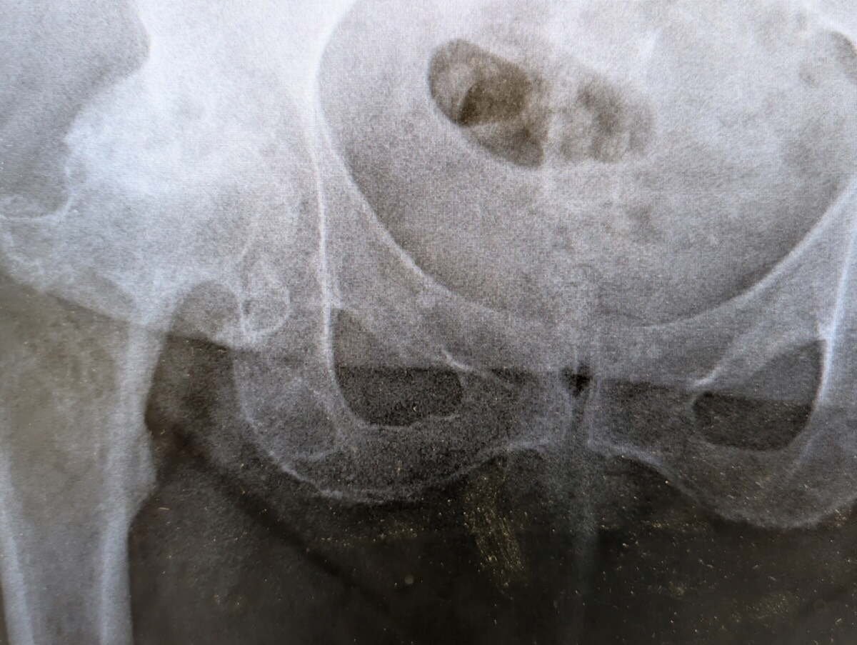 Radiograph of a hip with osteoarthritis and avascular necrosis