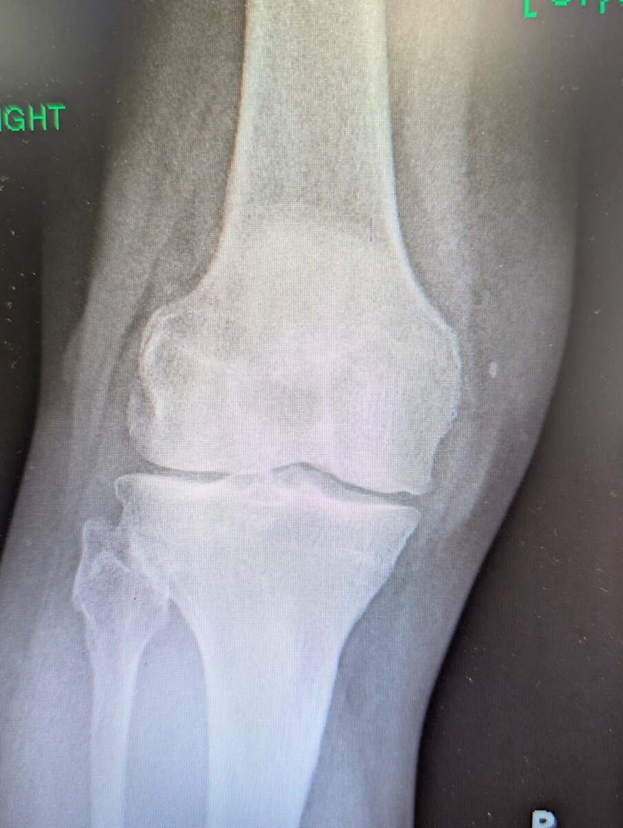 Weight-bearing radiograph of an arthritic knee before replacement