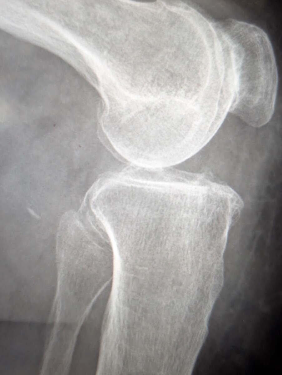 Weight-bearing radiograph of a knee with medial compartment arthritis