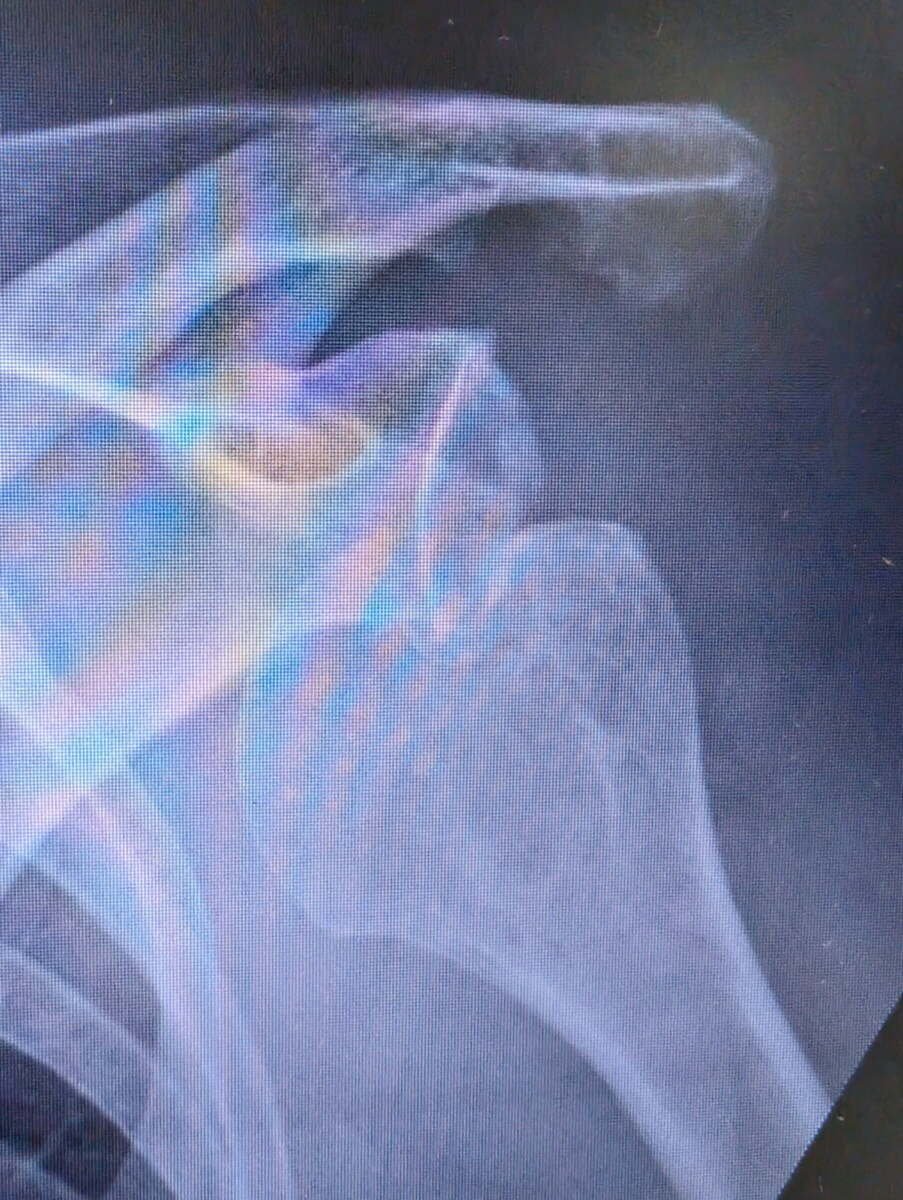 Radiograph of a chronic locked anterior shoulder dislocation