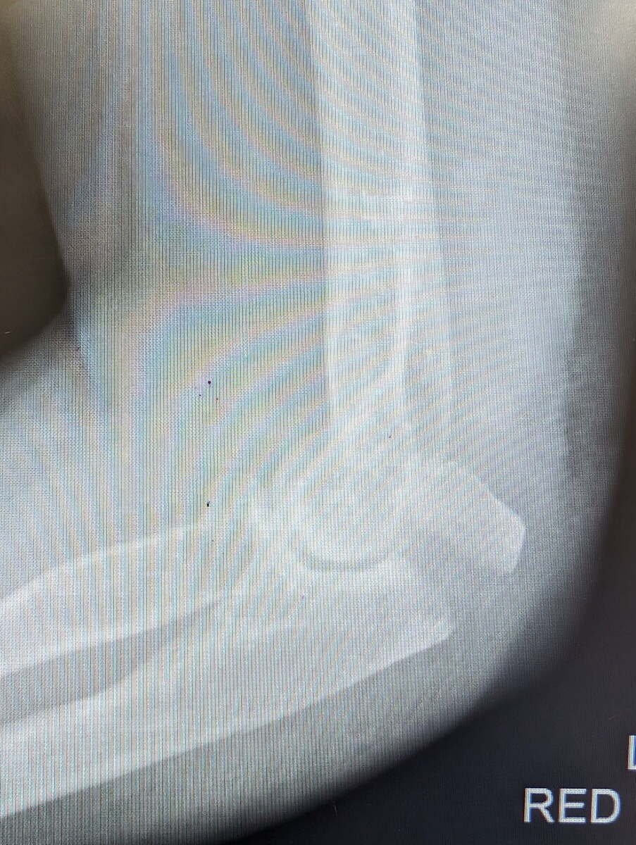 Radiograph of an olecranon fracture of the elbow
