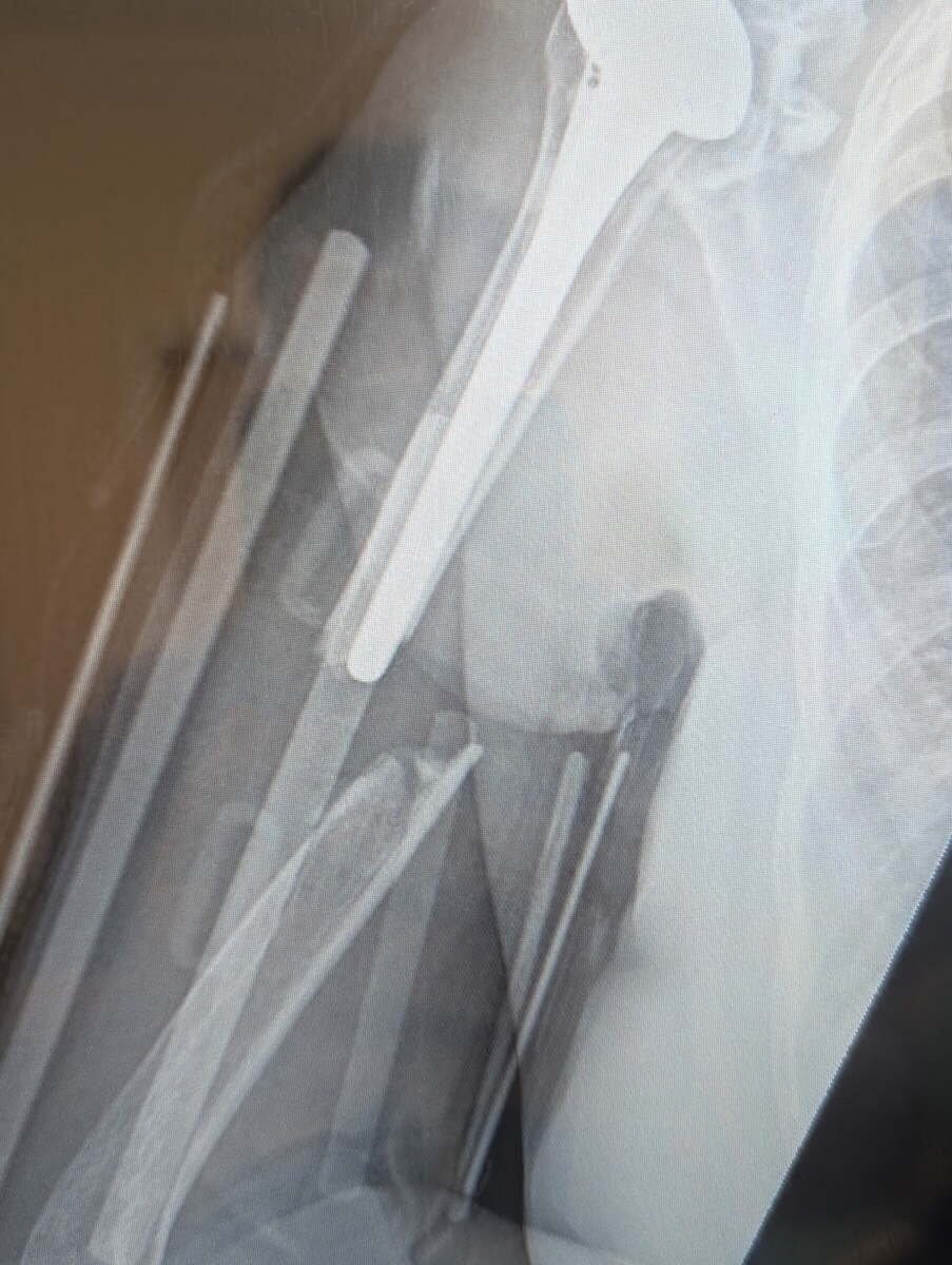 Radiograph of a periprosthetic humerus fracture around a shoulder replacement stem