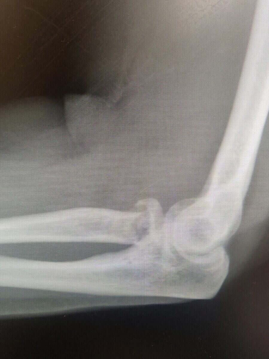 Radiograph of a radial head fracture of the elbow