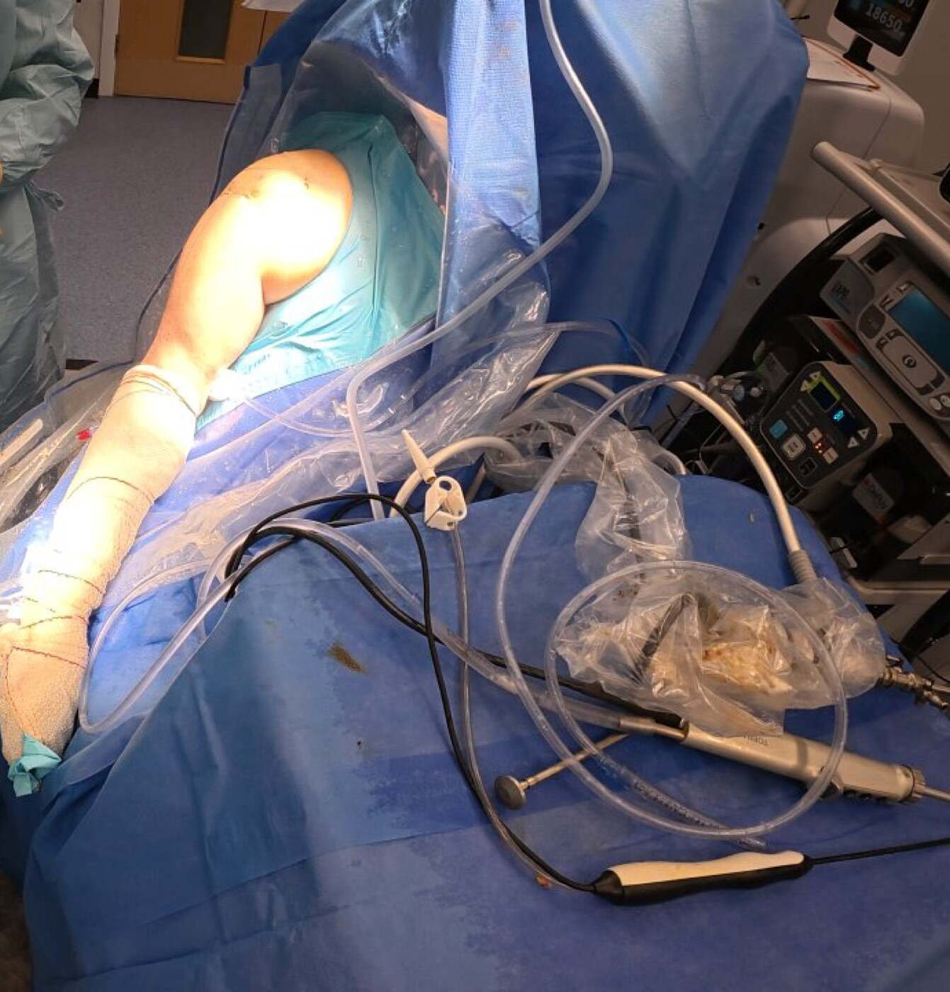 Operating theatre set up for shoulder arthroscopy in the beach chair position