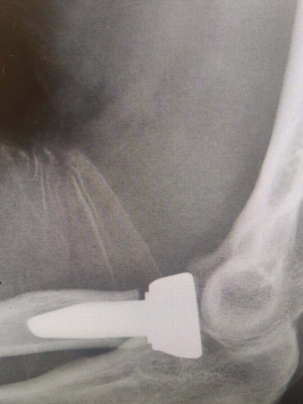 Radiograph of an elbow after radial head replacement following a terrible triad injury
