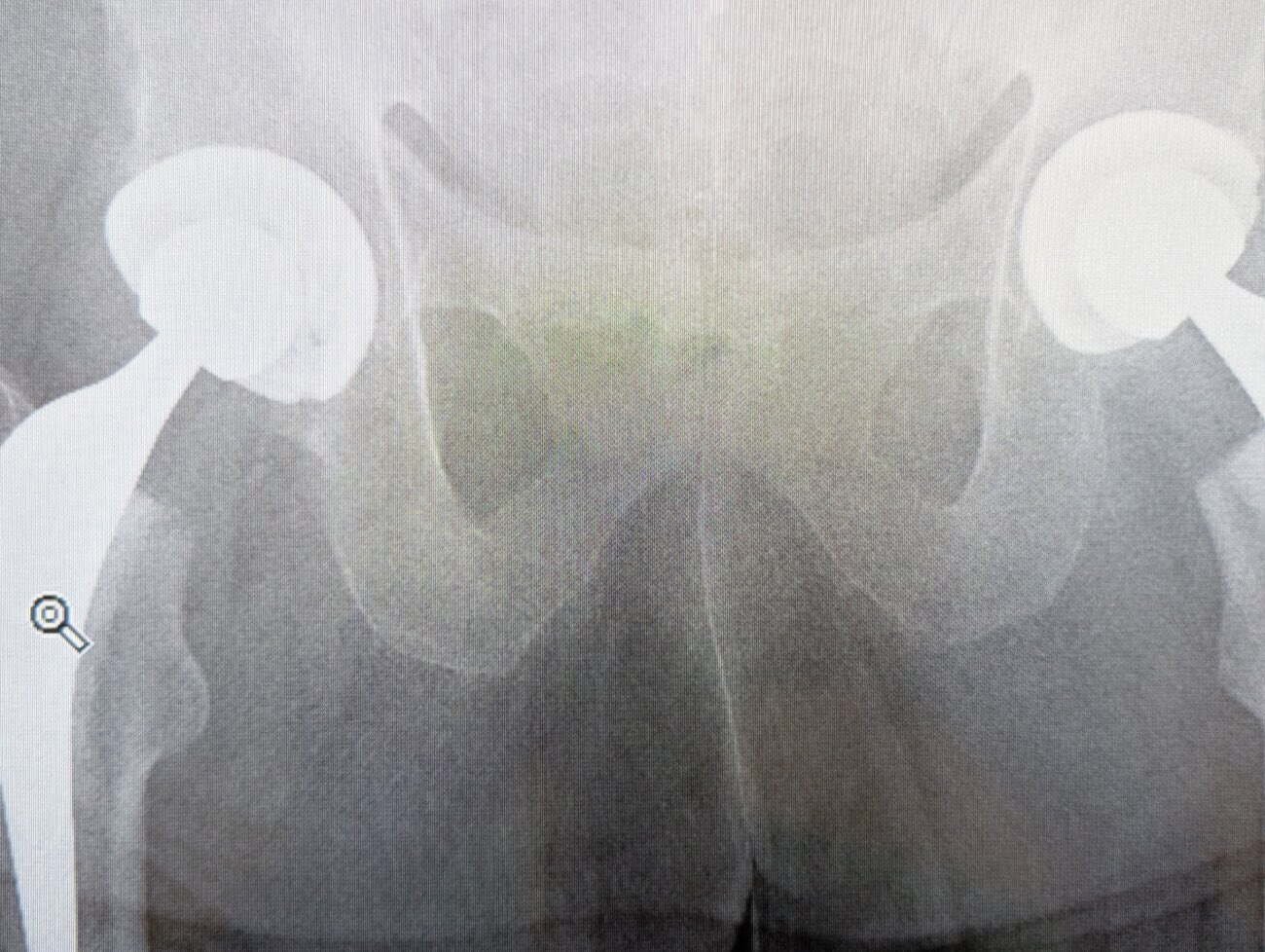 Radiograph of the pelvis showing bilateral total hip replacements