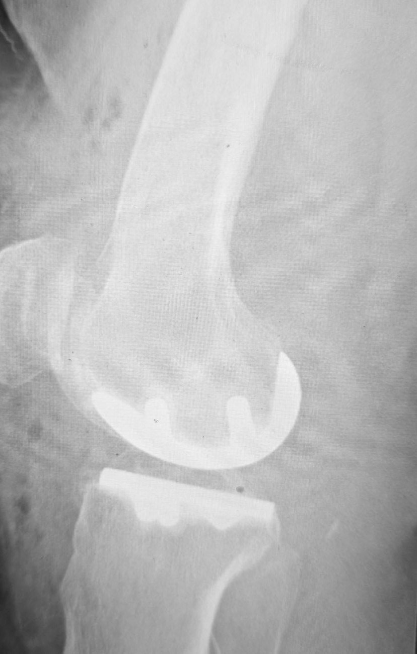 Radiograph of a medial unicompartmental (partial) knee replacement