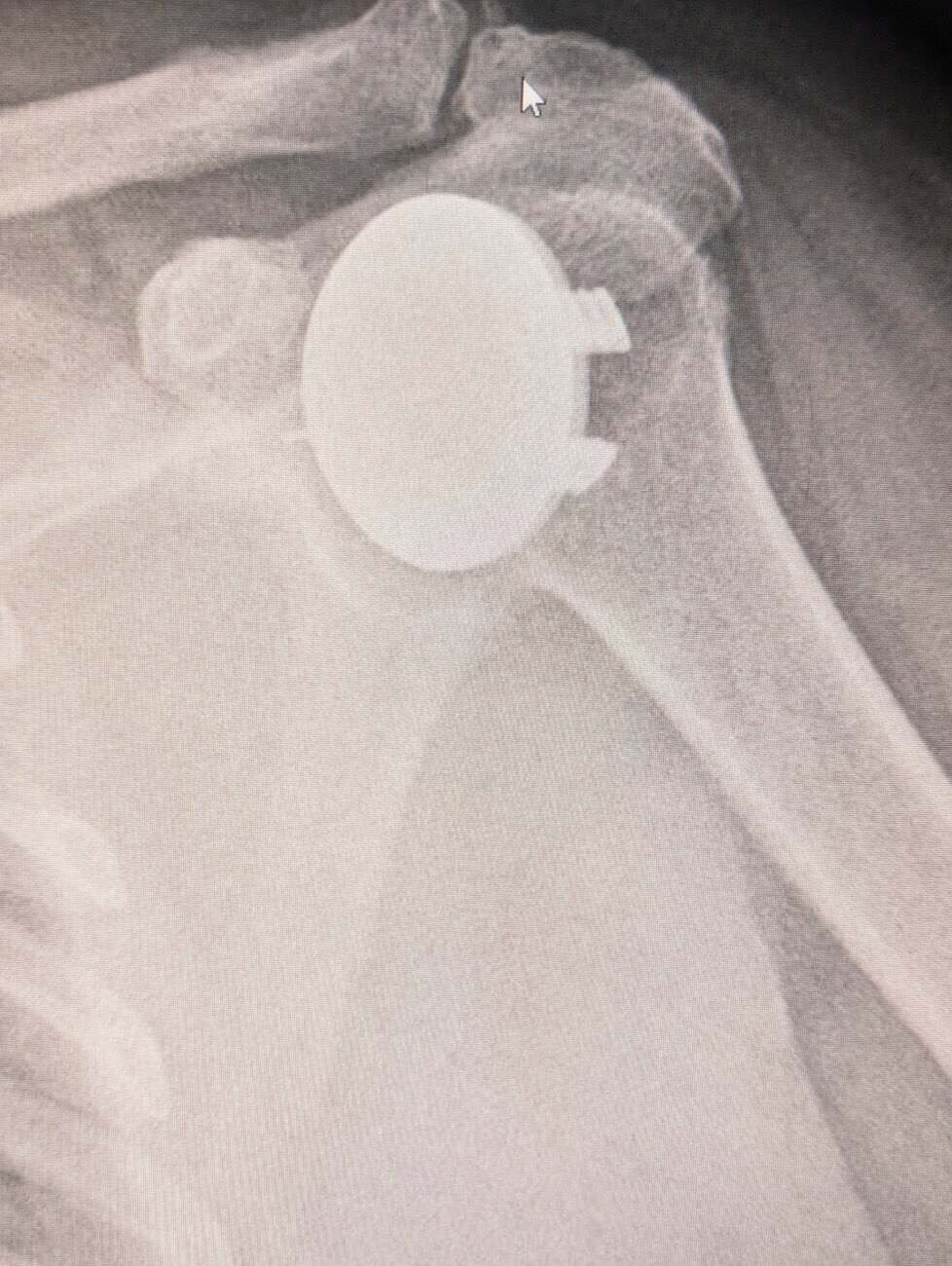 Radiograph showing an anatomic shoulder replacement in position