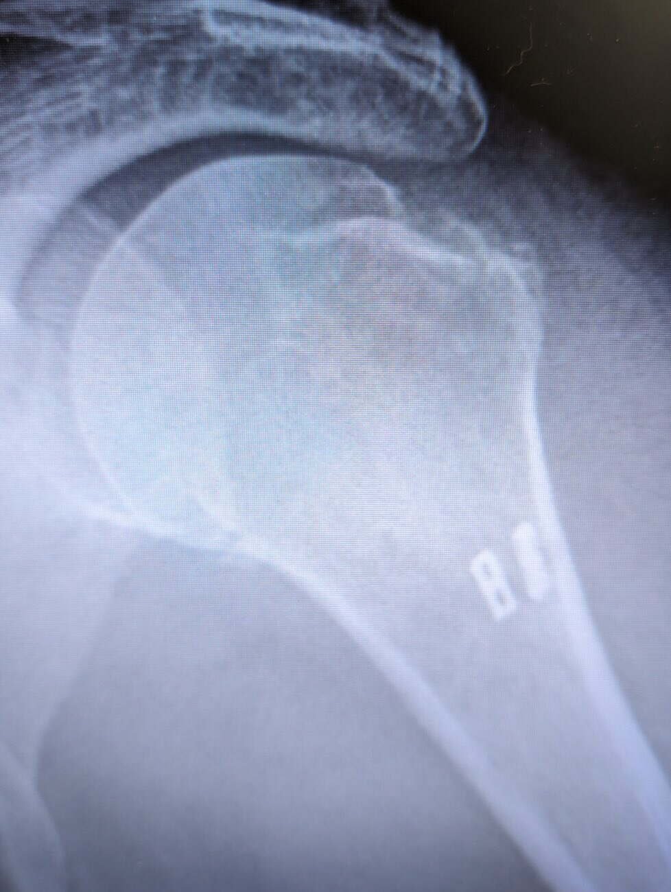 Radiograph of a greater tuberosity fracture of the shoulder repaired with endobuttons